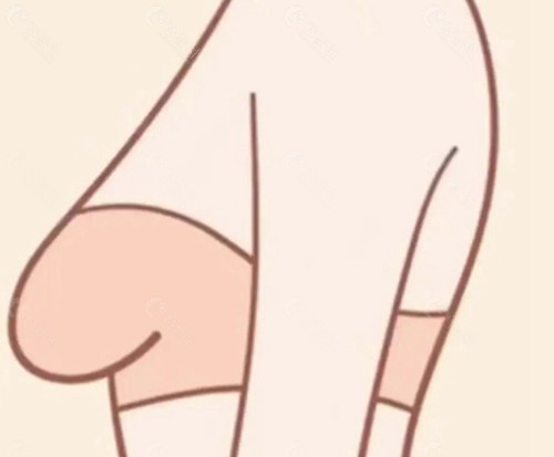 乳房悬吊手术花了六万多正常吗? 乳房悬吊手术花了六万多正常吗?