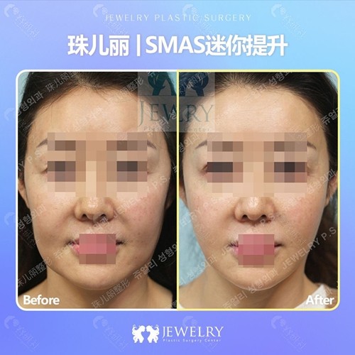 韩国珠儿丽迷你提升 韩国珠儿丽迷你提升