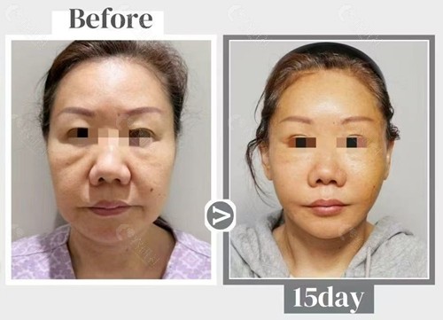 韩国歌娜整形医院筋膜大拉皮手术对比照 韩国歌娜整形医院筋膜大拉皮手术对比照