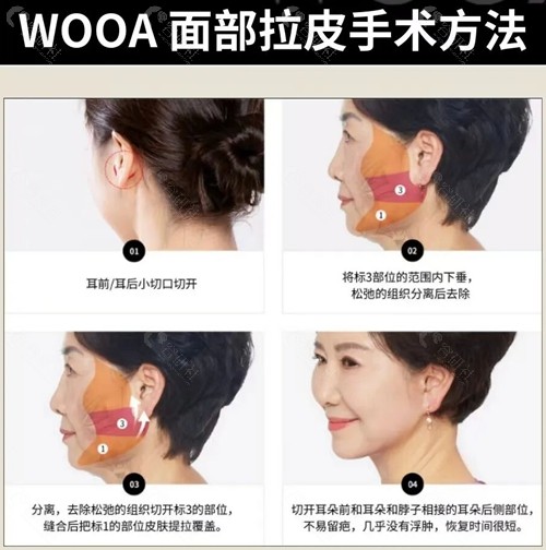 韩国面部大拉皮手术方法 韩国面部大拉皮手术方法