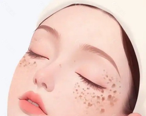 激光祛斑原理是什么? 激光祛斑原理是什么?