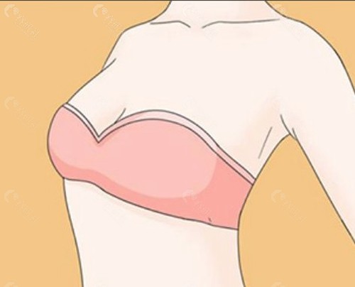 自体脂肪丰胸抽取哪里的脂肪? 自体脂肪丰胸抽取哪里的脂肪?