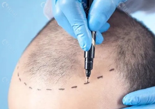 台州新生治疗脱发怎么样