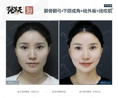 张笑天颧骨颧弓+下颌成角+祛外板+祛咬肌手术前后对比照1 张笑天颧骨颧弓+下颌成角+祛外板+祛咬肌手术前后对比照1