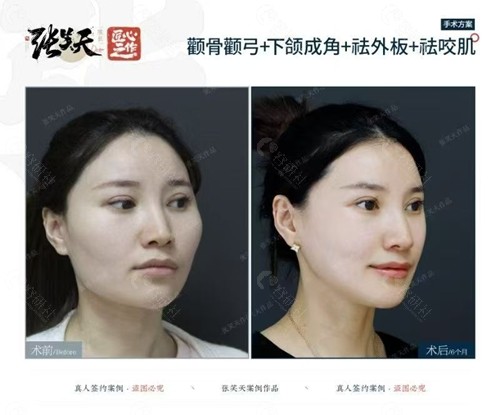 张笑天颧骨颧弓+下颌成角+祛外板+祛咬肌手术前后对比照2 张笑天颧骨颧弓+下颌成角+祛外板+祛咬肌手术前后对比照2