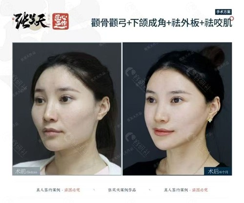 张笑天颧骨颧弓+下颌成角+祛外板+祛咬肌手术前后对比照4 张笑天颧骨颧弓+下颌成角+祛外板+祛咬肌手术前后对比照4