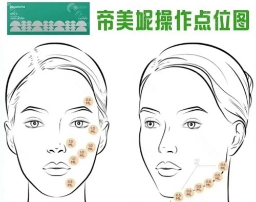 帝美尼提升针的作用原理