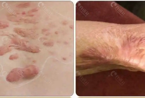 桂林美丽焦点祛疤痕 好吗