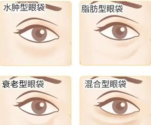 金华永康祛眼袋好吗