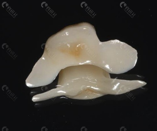 马里兰桥多少钱一颗牙？