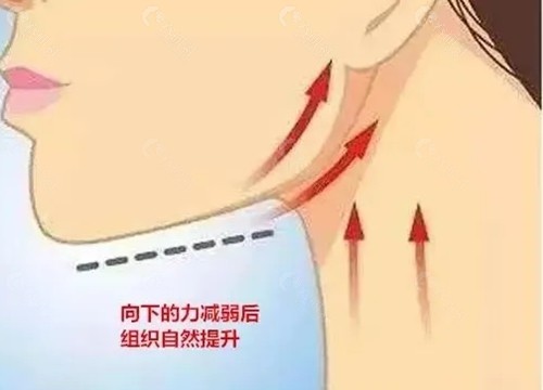 下颚线提升价格