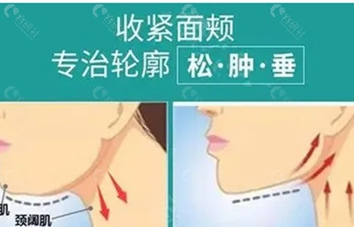 下颚线提升打轮廓针有效吗