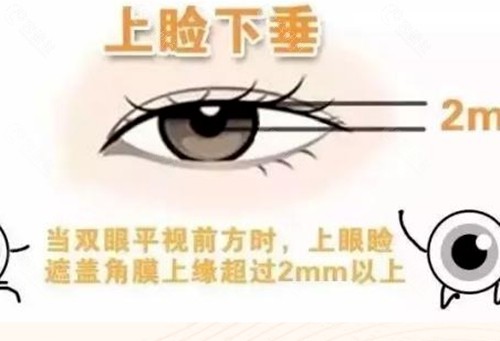张冰洁做上睑下垂矫正好吗