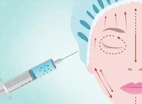 陈敏微整注射怎么样