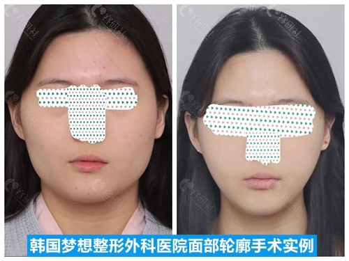韩国梦想整形外科面部轮廓整形手术对比照