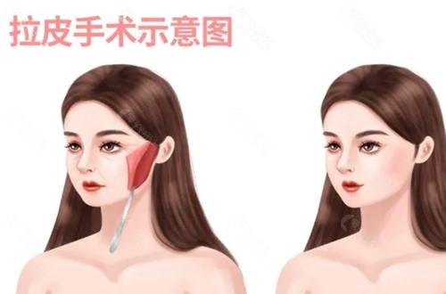 袁强拉皮手术怎么样