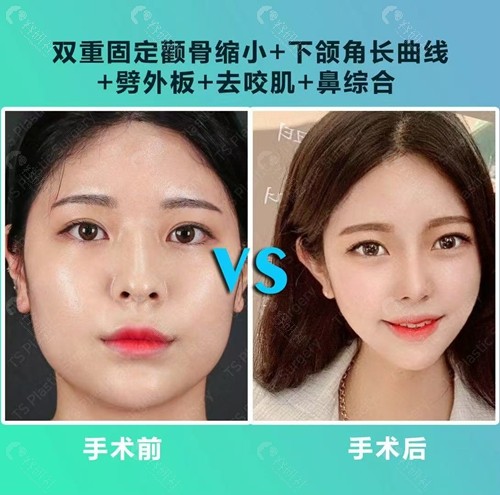 韩国TS医院面部轮廓手术怎么样？