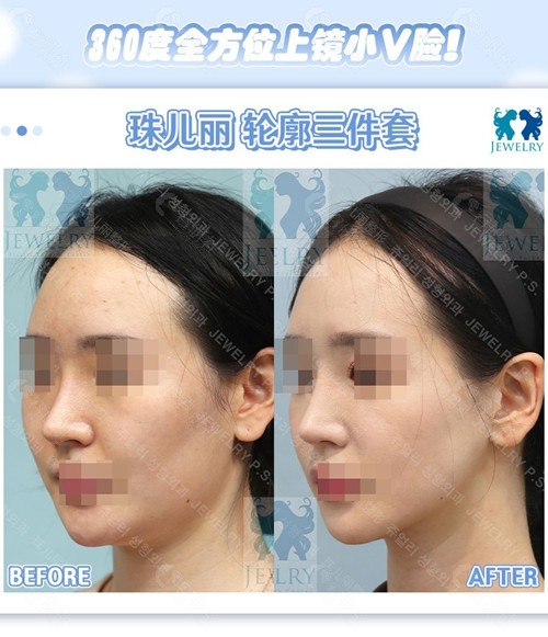 韩国珠儿丽轮廓三件套对比照