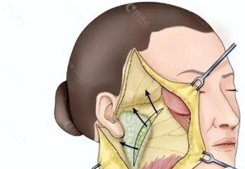 陈武拉皮手术好吗