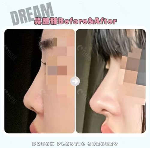 韩国梦想整形外科鼻整形对比照