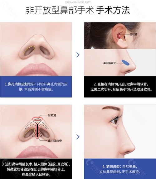 韩国梦想整形外科非开放型鼻部手术方法详解