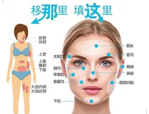 珠海华美脂肪填充怎么样