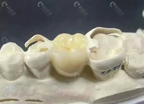 马里兰桥修复义齿图解