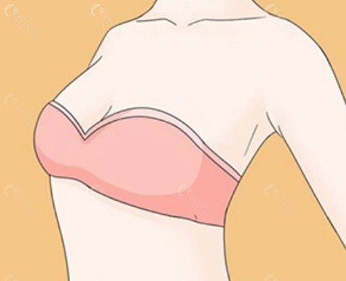乳房再造手术收费价格