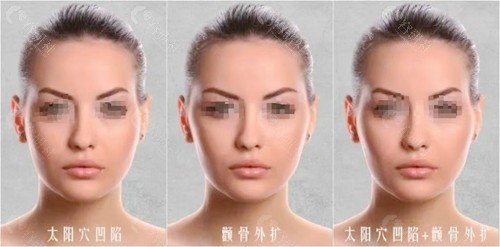太阳穴凹陷怎么变饱满？