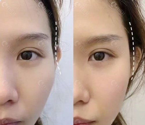 太阳穴凹陷填充有后遗症吗？