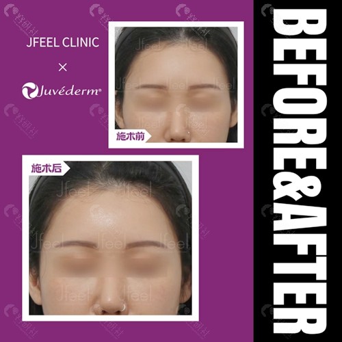 韩国Jfeel Clinic皮肤科乔雅登玻尿酸注射填充太阳穴对比图