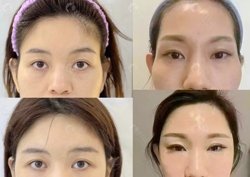 太阳穴凹陷填充对比照片