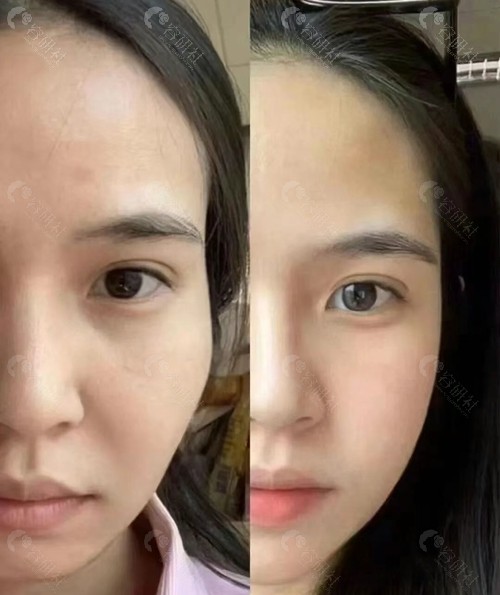 太阳穴凹陷填充术前术后对比照