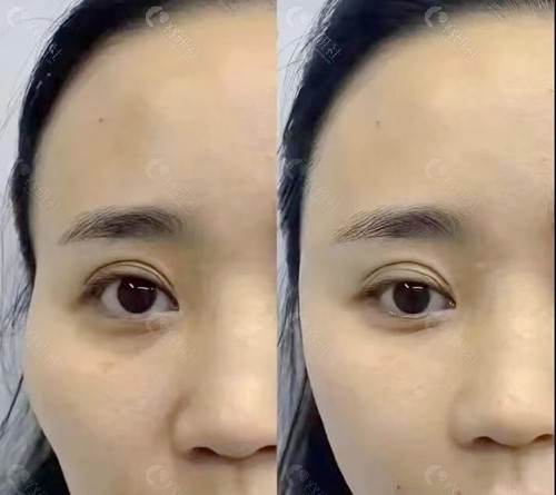 太阳穴凹陷填充对比图