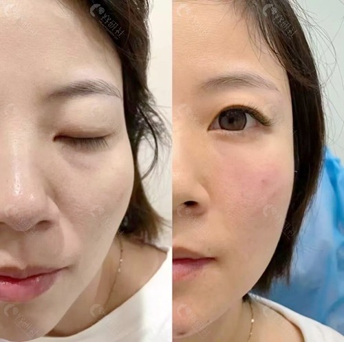 太阳穴凹陷填充前后图片