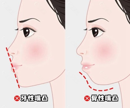 牙性凸嘴矫正手术价格为3万元起。