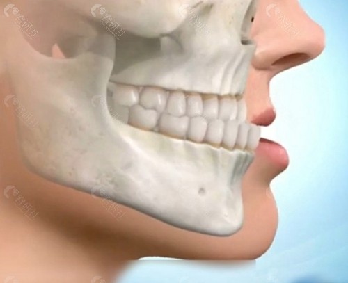 3D导板正颌手术价格为6万元起。