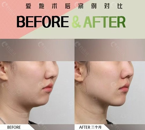 韩国爱她整形医院狐狸V脸术前后对比照