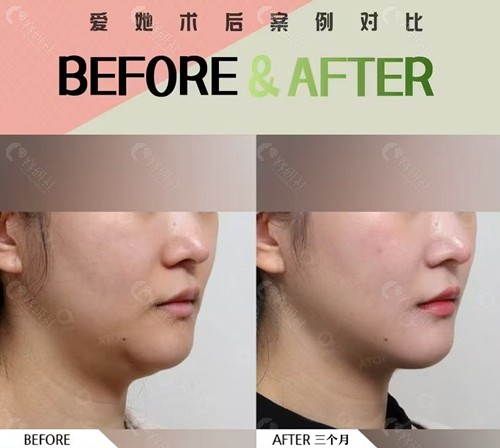 韩国爱她整形外科医院狐狸V脸术前后对比照