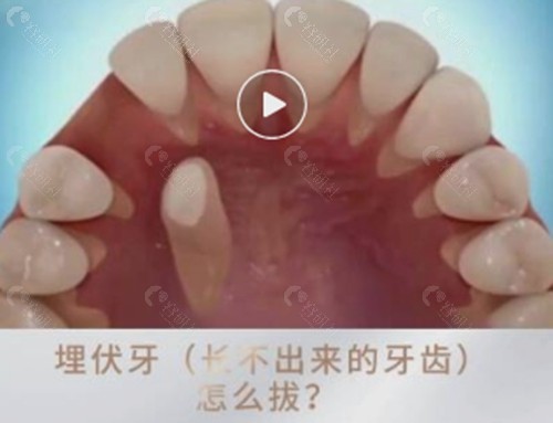 埋伏牙牵引正畸费用贵吗