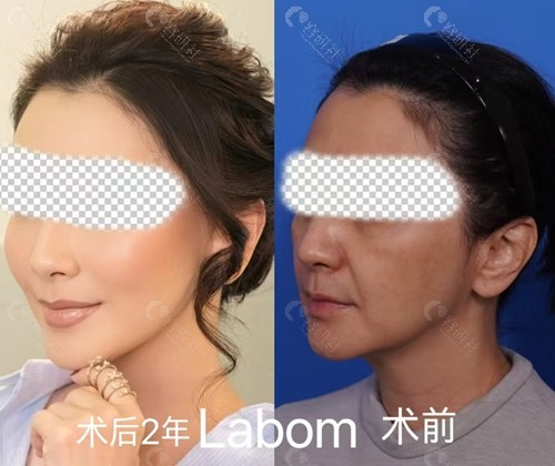 韩国拉本整形医院面部拉皮手术2年后反馈图