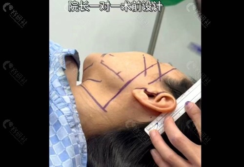 韩国拉本整形医院面部拉皮手术前设计