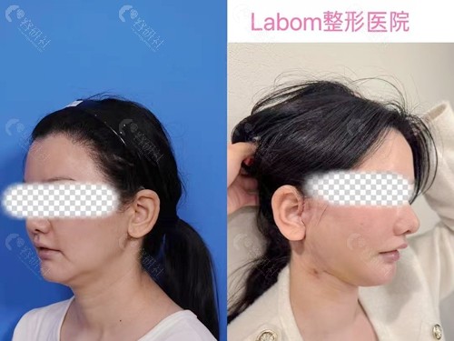 韩国拉本整形医院面部拉皮手术前和术后对比图