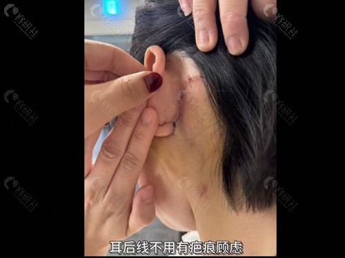 韩国拉本整形医院面部拉皮手术后恢复情况