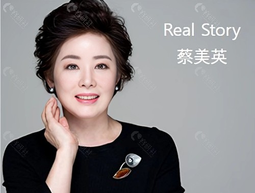 韩国梦想整形外科医院微创SMAS提拉术后照片