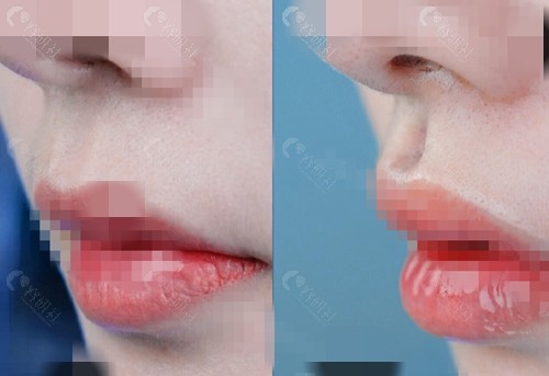 人中窝加深整形手术对比照