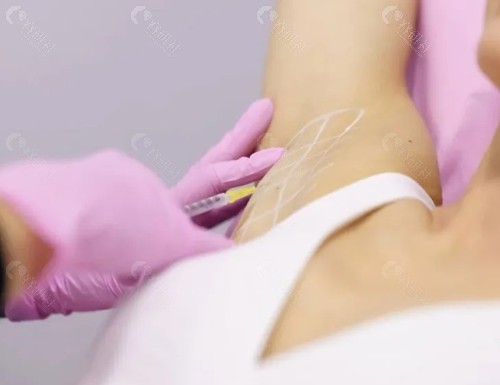 腋臭怎么治疗