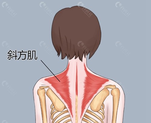 斜方肌打瘦肩针多少钱？