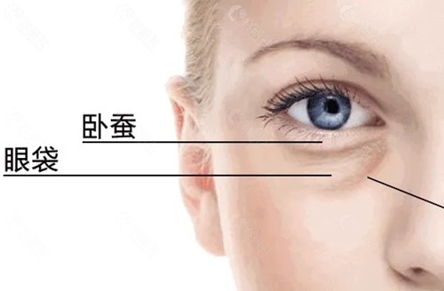 西安叶子割眼袋怎么样
