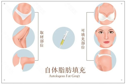 程红涛医生脂肪填充好吗